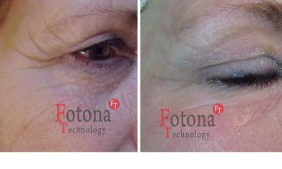 Фотона Глаза 7